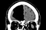 【頭が空っぽ】８４歳男性患者の脳内に直径９センチの空洞　北アイルランド