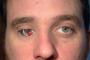【医療】事故で片目を失った男性　小型カメラを備えた人工眼球を瞳に　進化するサイボーグ技術　カナダ