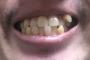 【驚画像】歯を見せて笑えないワイの歯がこちらなんやけどwwwww
