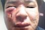 【サヨク画報】しばき隊リンチ事件(所謂｢十三ベース事件｣)の被害者の受傷直後の画像ｷﾀ━(ﾟ∀ﾟ)━ｯ!!