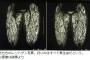 【閲覧注意】豚の生肉を食べた女、全身に寄生虫が寄生　うわあああああああ・・・（画像あり）