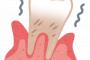 【相談】急性歯周病になって歯茎に膿が溜まり、歯医者で手術した。膿が出て痛みから解放された。しかし、その２日後