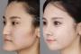 韓国・ソウルで鼻と顔の輪郭を直す整形手術を受けた20代の日本人女性、宿泊先のホテルで死亡 … 手術4日後、ブローカーが宿泊先にて発見