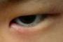 【悲報】目の下がくっそ腫れてて痛い