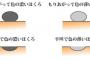 おんj ほくろ切ってみたら血が止まらなくなった部
