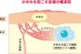 梅雨前に激増する「股間がかゆい！」　その原因は？