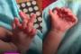 【画像】インドで手足に合計26本の指を持つ赤ちゃんが誕生、女神の生まれ変わりだと話題に