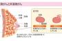 【衝撃】小林麻央さんの命奪った乳がん、意外と知らない基礎知識・・・