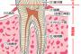 【悲報】歯の詰め物が取れたから歯医者に行った結果ｗｗｗｗｗｗ