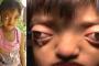 眼球が飛び出しカエルと虐められれいた少女、やっと手術へ。。。→海外「人と違うからって虐めていいわけないのに。」