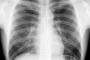 【戦慄】クリニックで肺がん検診 → 異常を見落とされた回数がヤバい・・・・・