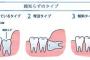 親不知の抜歯とかいう拷問wwww