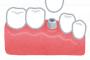 【衝撃】 奥歯２本に「インプラント」入れた結果 →