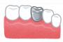 銀歯を全部セラミックに変えてみた。すると衝撃な効果が…